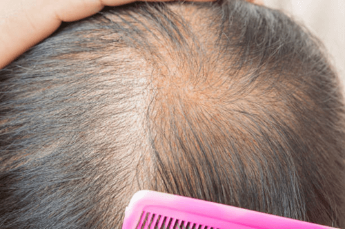 rawatan rambut gugur